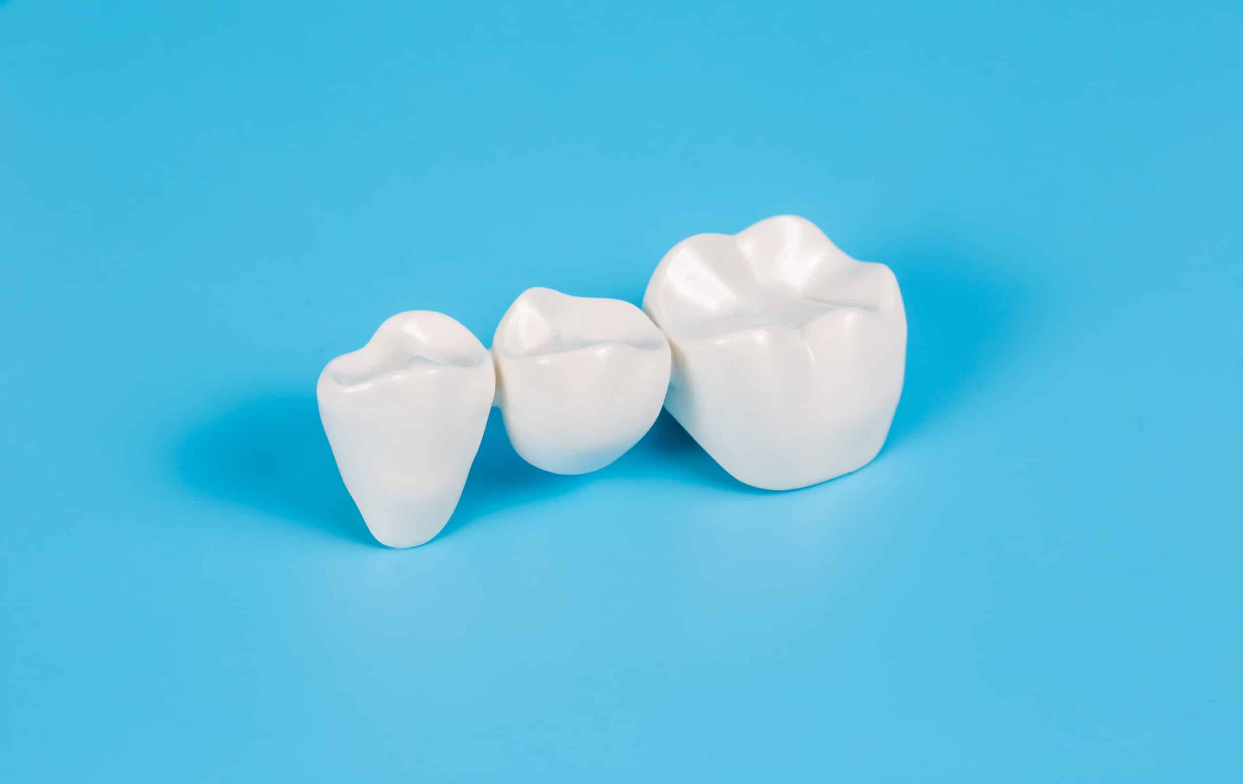 How to Clean Under a Dental Bridge