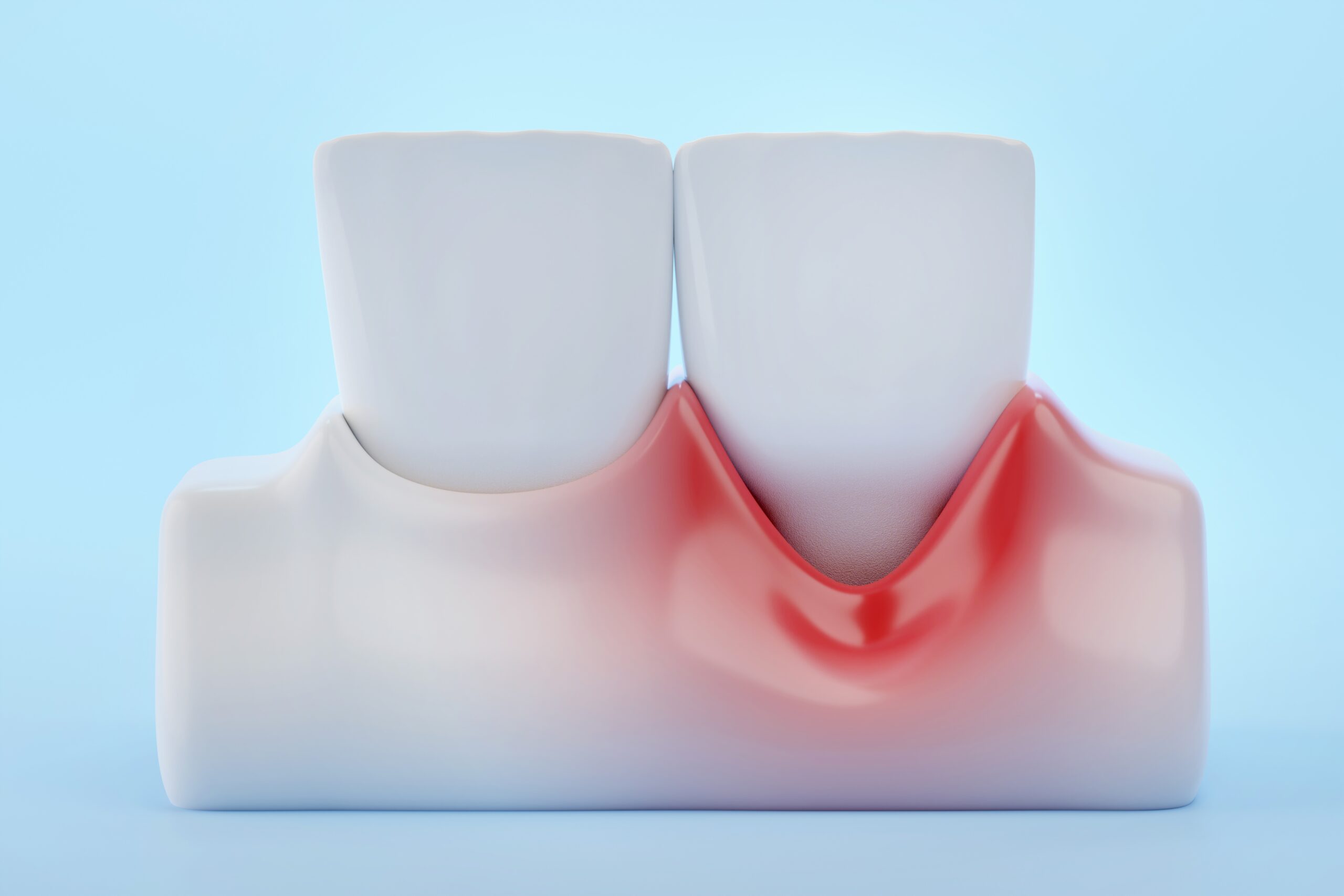 Tips for Avoiding Gum Recession