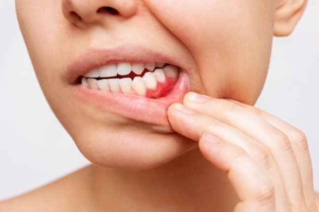 Cropped shot of a young woman showing red swollen gums isolated on a white background.