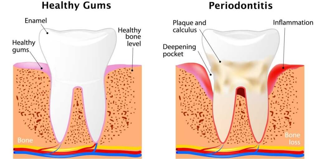 Healthy Gums and Periodontics image