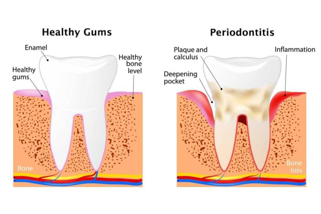 About Periodontal Disease